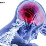 Stroke, Kejang, Brain fog, dan Efek Neurologis dari COVID-19